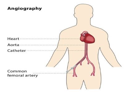 Angiography